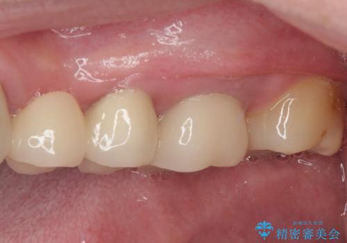 奥歯がしみる　オールセラミッククラウンによる奥歯のむし歯治療の治療後