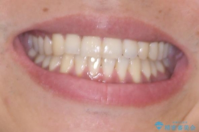矯正後の後戻りをインビザラインライトで再治療|目立たない矯正の症例紹介の治療後(顔貌)