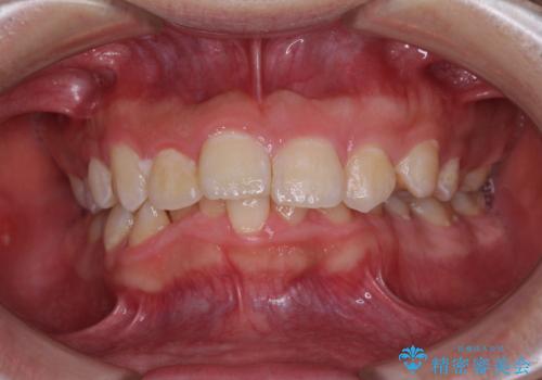 左右に顎がずれた咬み合わせ ワイヤー矯正で咬み合わせを改善