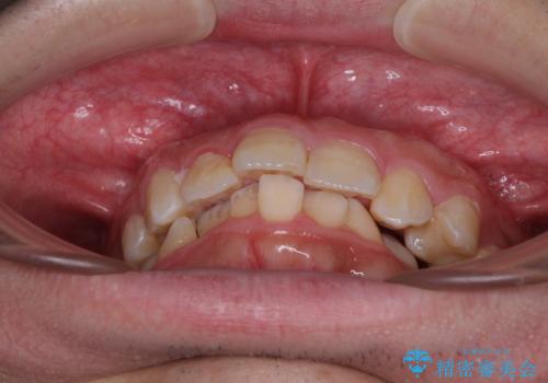 左右に顎がずれた咬み合わせ ワイヤー矯正で咬み合わせを改善の治療前