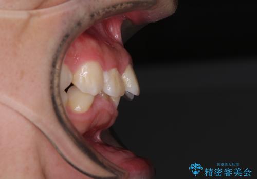 左右に顎がずれた咬み合わせ ワイヤー矯正で咬み合わせを改善の治療前