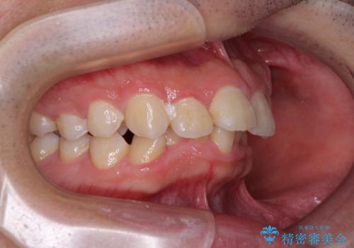 左右に顎がずれた咬み合わせ　ワイヤー矯正で咬み合わせを改善の治療前