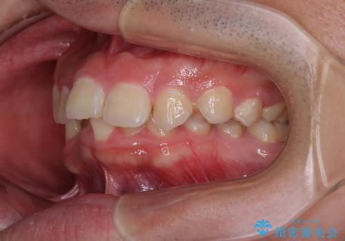 左右に顎がずれた咬み合わせ　ワイヤー矯正で咬み合わせを改善の治療前