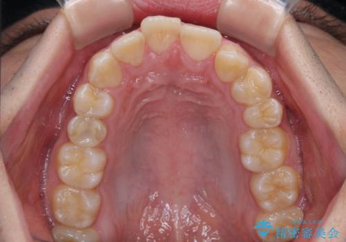 左右に顎がずれた咬み合わせ ワイヤー矯正で咬み合わせを改善の治療前