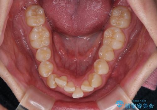 左右に顎がずれた咬み合わせ　ワイヤー矯正で咬み合わせを改善の治療前