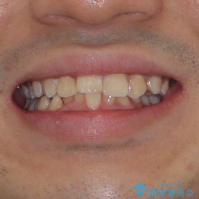 左右に顎がずれた咬み合わせ ワイヤー矯正で咬み合わせを改善の治療前(顔貌)
