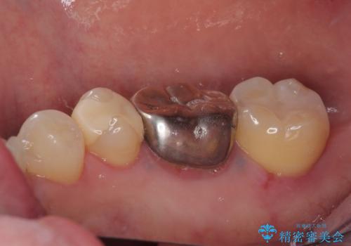 銀の詰め物を白くしたいの治療後