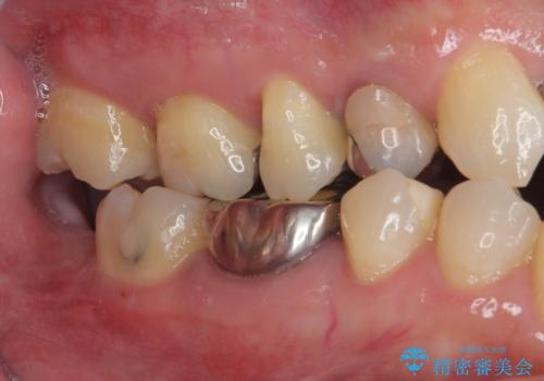 銀の詰め物を白くしたいの治療後