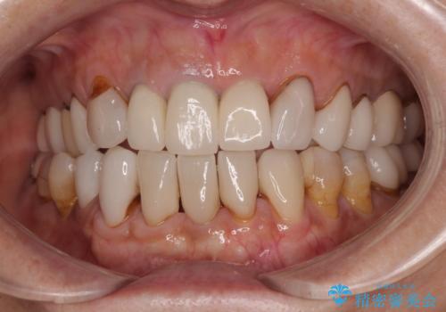 不釣り合いで境目の露出した前歯 オールセラミッククラウンによる審美歯科治療の治療前