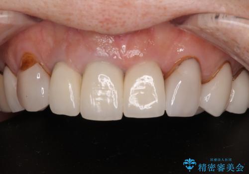 不釣り合いで境目の露出した前歯 オールセラミッククラウンによる審美歯科治療の治療前