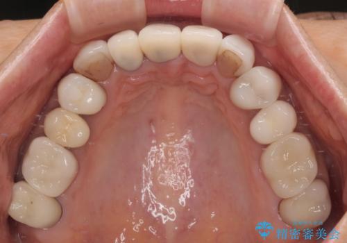 不釣り合いで境目の露出した前歯　オールセラミッククラウンによる審美歯科治療の治療前