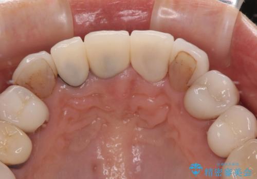 不釣り合いで境目の露出した前歯 オールセラミッククラウンによる審美歯科治療の治療前