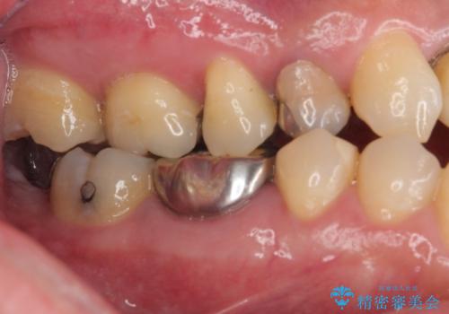 銀の詰め物を白くしたいの治療前