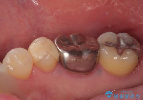 銀の詰め物を白くしたいの治療前