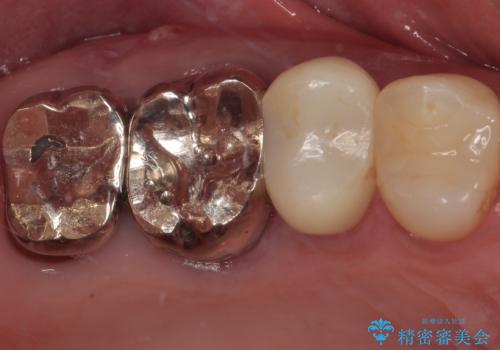 欠けた詰め物を精密セラミックインレーで自然に修復した症例の症例 治療後