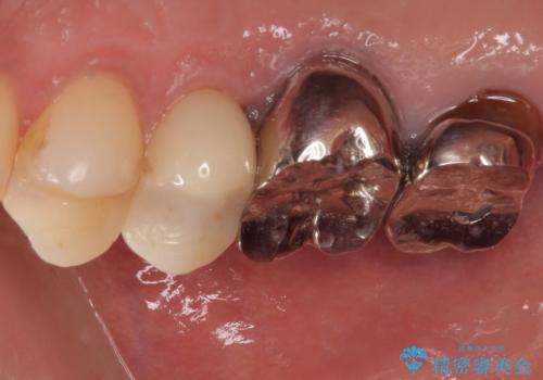 欠けた詰め物を精密セラミックインレーで自然に修復した症例の治療後