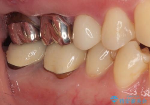欠けた詰め物を精密セラミックインレーで自然に修復した症例の治療後