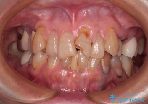 長年気になっていた前歯　矯正治療と補綴治療による審美歯科治療