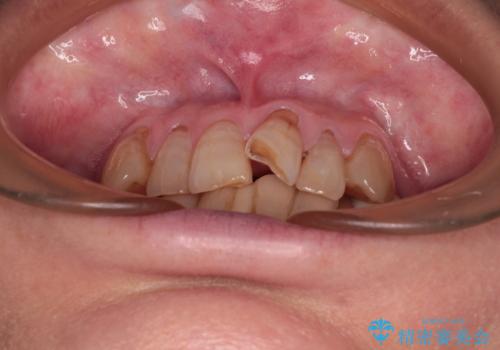 長年気になっていた前歯 矯正治療と補綴治療による審美歯科治療の治療前