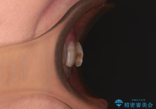 長年気になっていた前歯 矯正治療と補綴治療による審美歯科治療の治療前