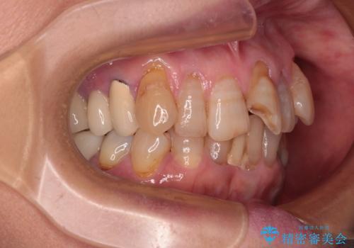 長年気になっていた前歯　矯正治療と補綴治療による審美歯科治療の治療前