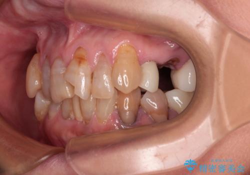 長年気になっていた前歯　矯正治療と補綴治療による審美歯科治療の治療前