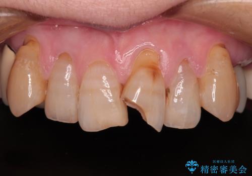 長年気になっていた前歯　矯正治療と補綴治療による審美歯科治療の治療前