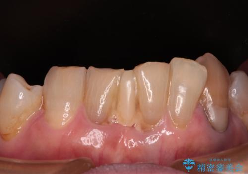 長年気になっていた前歯　矯正治療と補綴治療による審美歯科治療の治療前