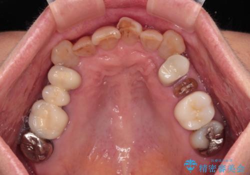 長年気になっていた前歯 矯正治療と補綴治療による審美歯科治療の治療前