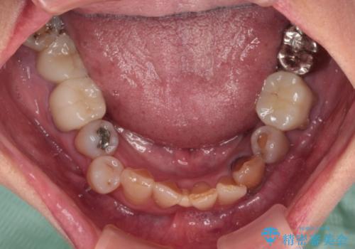 長年気になっていた前歯 矯正治療と補綴治療による審美歯科治療の治療前