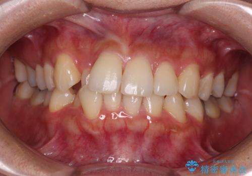 【モニター】閉じにくい前歯とクロスバイト　ワイヤー装置での抜歯矯正