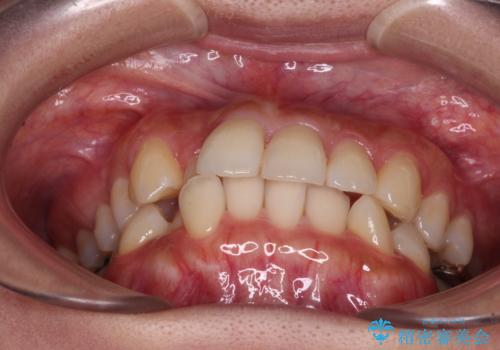 【モニター】閉じにくい前歯とクロスバイト ワイヤー装置での抜歯矯正の治療前