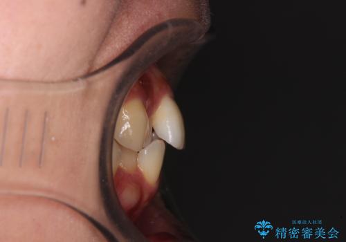 【モニター】閉じにくい前歯とクロスバイト ワイヤー装置での抜歯矯正の治療前