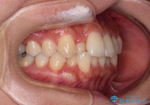 【モニター】閉じにくい前歯とクロスバイト ワイヤー装置での抜歯矯正の治療前