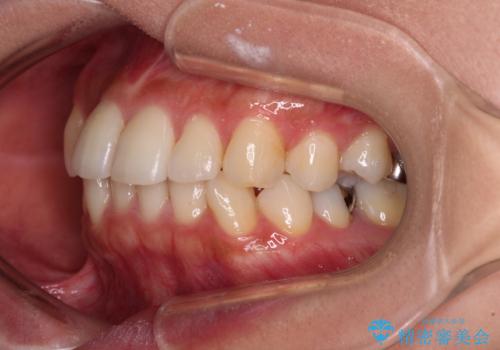 【モニター】閉じにくい前歯とクロスバイト ワイヤー装置での抜歯矯正の治療前