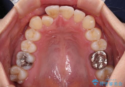 【モニター】閉じにくい前歯とクロスバイト　ワイヤー装置での抜歯矯正の治療前