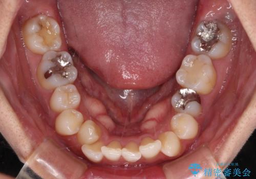 【モニター】閉じにくい前歯とクロスバイト　ワイヤー装置での抜歯矯正の治療前