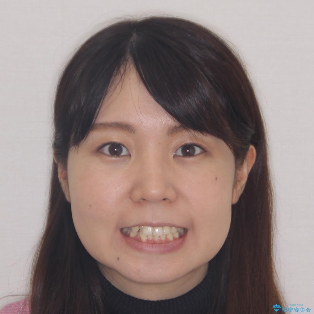 【モニター】閉じにくい前歯とクロスバイト ワイヤー装置での抜歯矯正の治療前(顔貌)