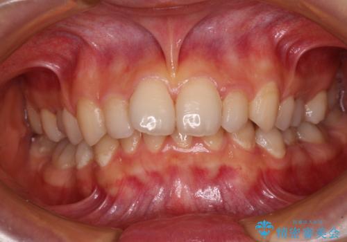 欠損や残存乳歯、深い咬み合わせ ワイヤー矯正で咬合改善の症例 治療前