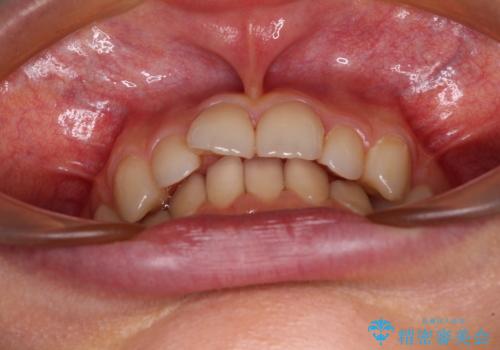 欠損や残存乳歯、深い咬み合わせ ワイヤー矯正で咬合改善の治療前