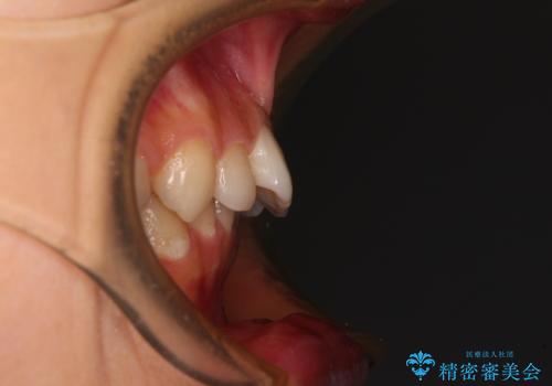 欠損や残存乳歯、深い咬み合わせ　ワイヤー矯正で咬合改善の治療前