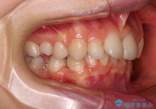 欠損や残存乳歯、深い咬み合わせ　ワイヤー矯正で咬合改善の治療前