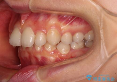 欠損や残存乳歯、深い咬み合わせ ワイヤー矯正で咬合改善の治療前