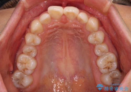 欠損や残存乳歯、深い咬み合わせ ワイヤー矯正で咬合改善の治療前