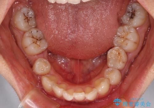 欠損や残存乳歯、深い咬み合わせ　ワイヤー矯正で咬合改善の治療前