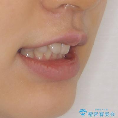 欠損や残存乳歯、深い咬み合わせ ワイヤー矯正で咬合改善の治療前(顔貌)