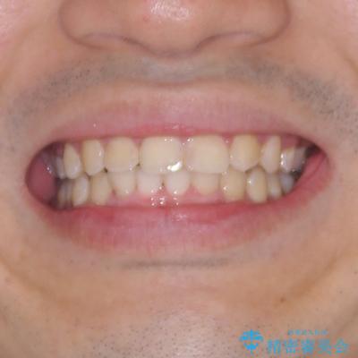 左右に顎がずれた咬み合わせ ワイヤー矯正で咬み合わせを改善の治療後(顔貌)
