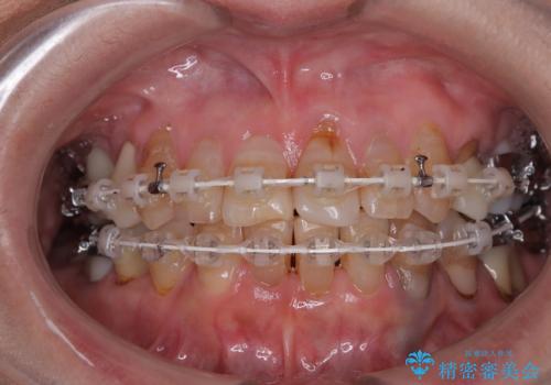 長年気になっていた前歯　矯正治療と補綴治療による審美歯科治療の治療中