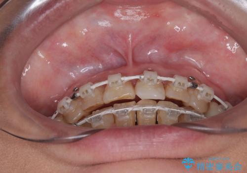 長年気になっていた前歯　矯正治療と補綴治療による審美歯科治療の治療中