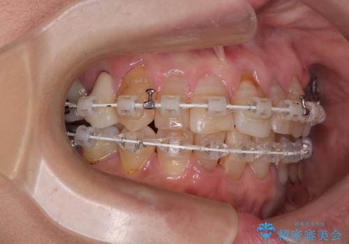 長年気になっていた前歯 矯正治療と補綴治療による審美歯科治療の治療中